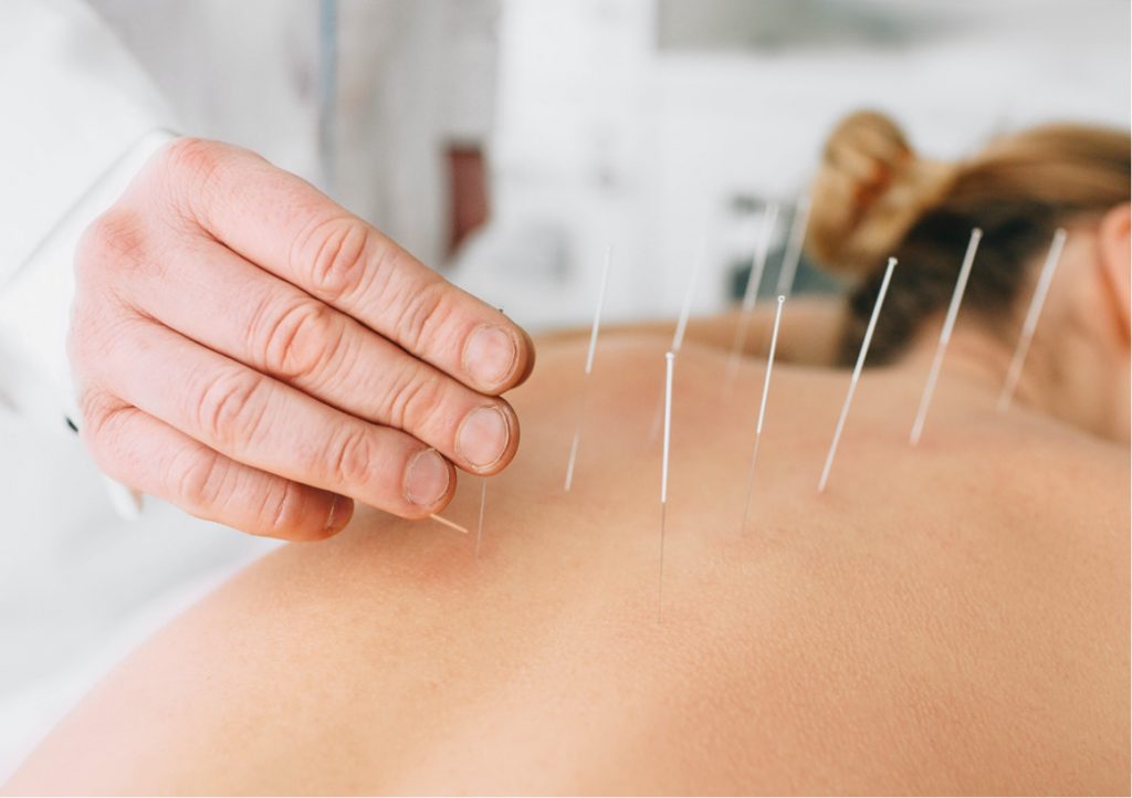 dry-needling